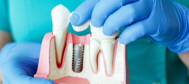 NEW: Ceramic coated dental implants