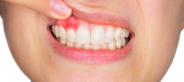 What to do about bleeding gums