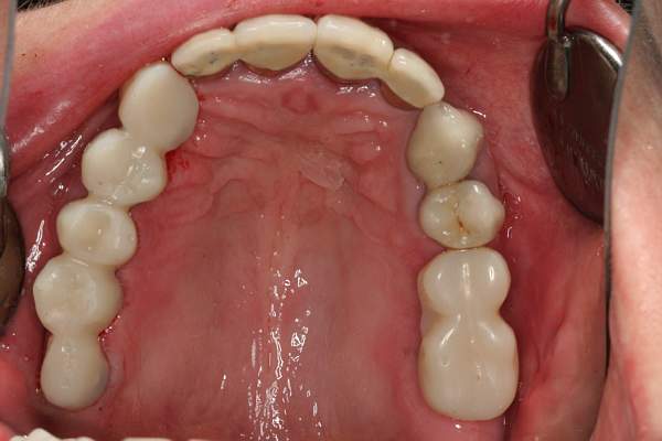 Bridge on immediately loadable dental implants