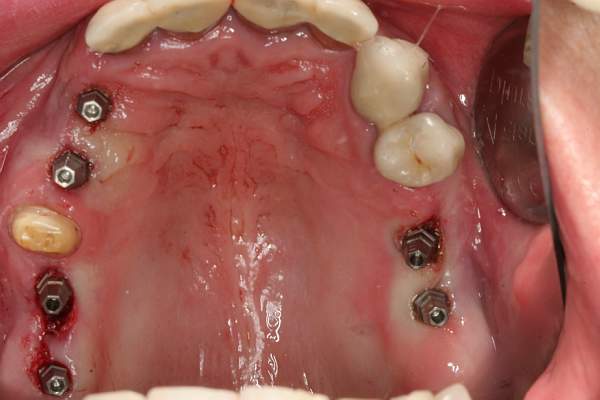 placed immediate implants in the upper jaw