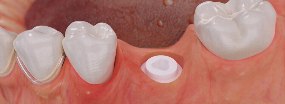 Organic dental implants