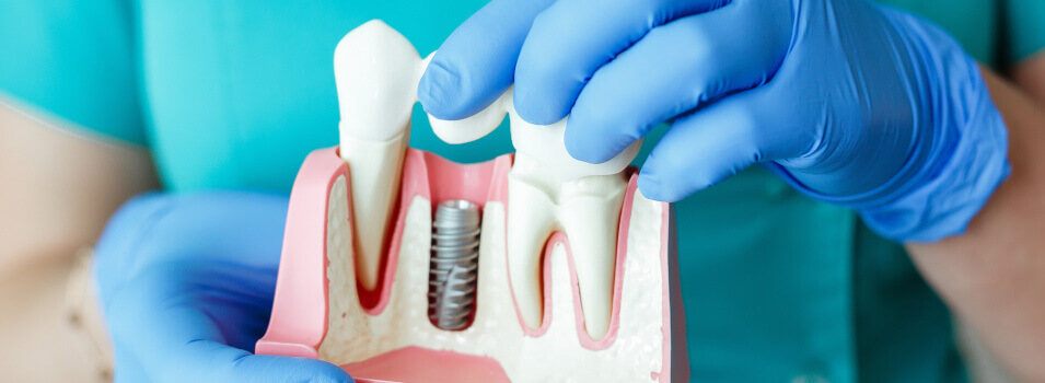 Bio-Ceramic coated dental implants